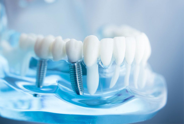 Dental Implants