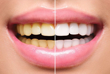 Dental Bleaching