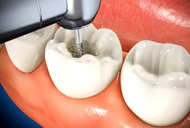 Root Canal Treatment